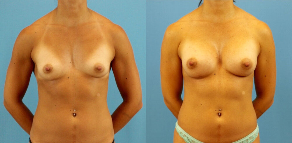 Breast Augmentation case #6315