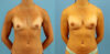 Breast Augmentation case #6315 slider thumbnail