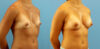 Breast Augmentation case #6315 slider thumbnail