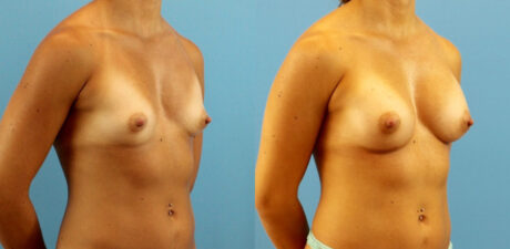 Breast Augmentation case #6315