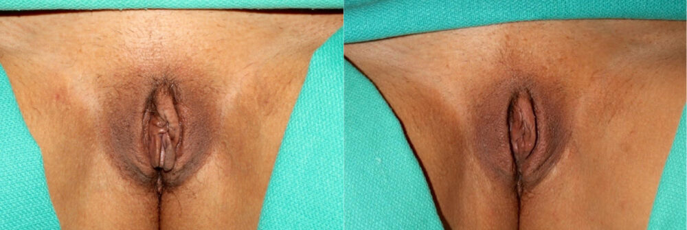 Labiaplasty case #5756