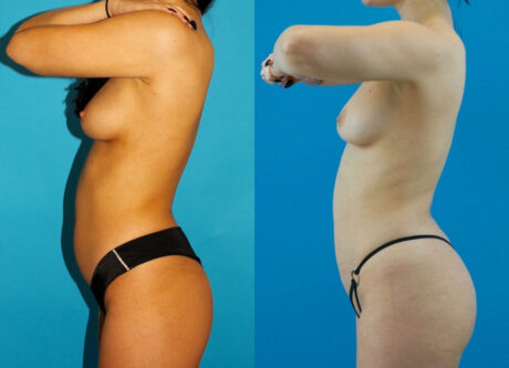 Brazilian Butt Lift case #4907