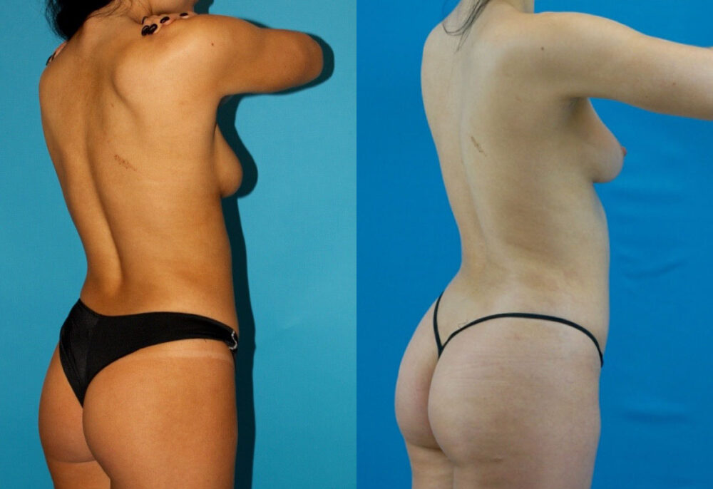 Brazilian Butt Lift case #4907