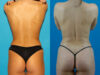 Brazilian Butt Lift case #4907 slider thumbnail