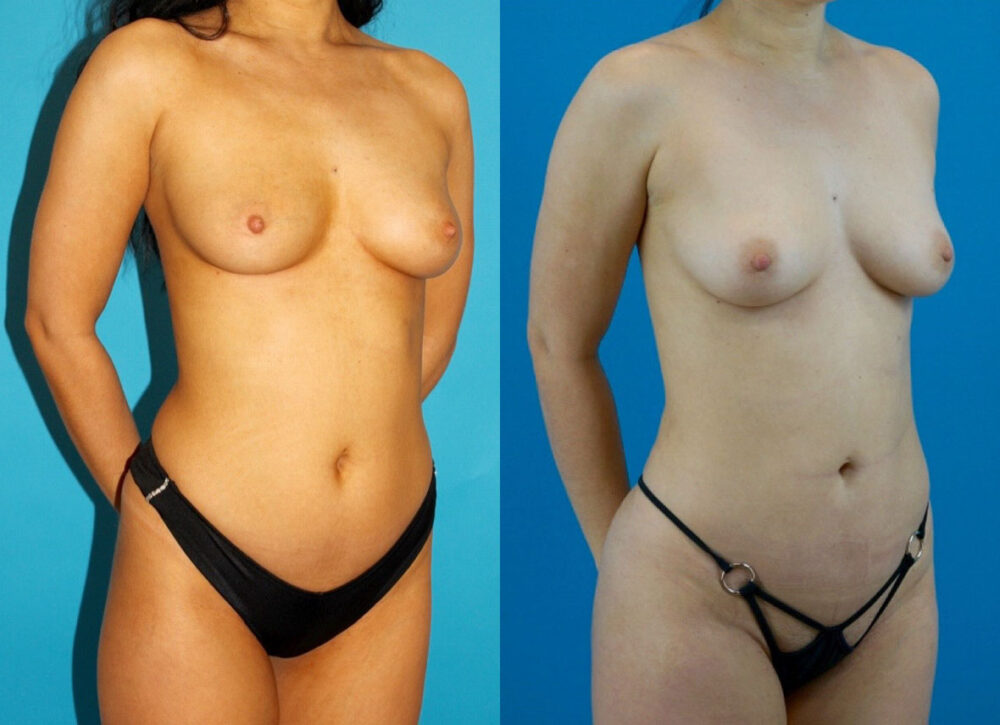 Brazilian Butt Lift case #4907