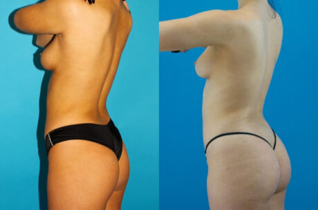 Brazilian Butt Lift case #4907