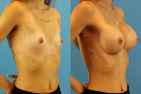 Breast Augmentation case #6321