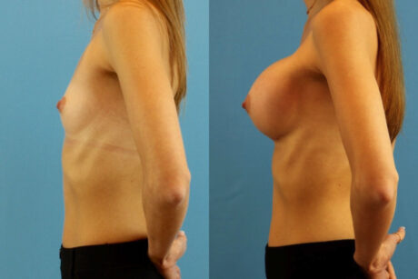 Breast Augmentation case #6321