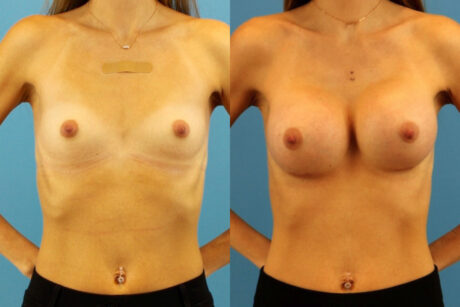 Breast Augmentation case #6321