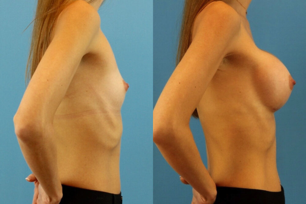 Breast Augmentation case #6321