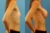 Breast Augmentation case #6321 slider thumbnail