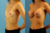 Breast Augmentation case #6321 slider thumbnail