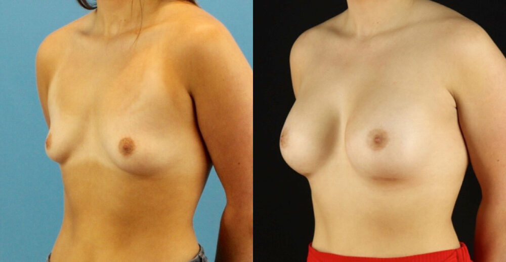 Breast Augmentation case #6327