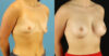 Breast Augmentation case #6327 slider thumbnail