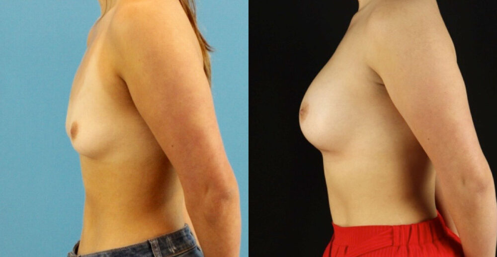 Breast Augmentation case #6327
