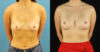 Breast Augmentation case #6327 slider thumbnail