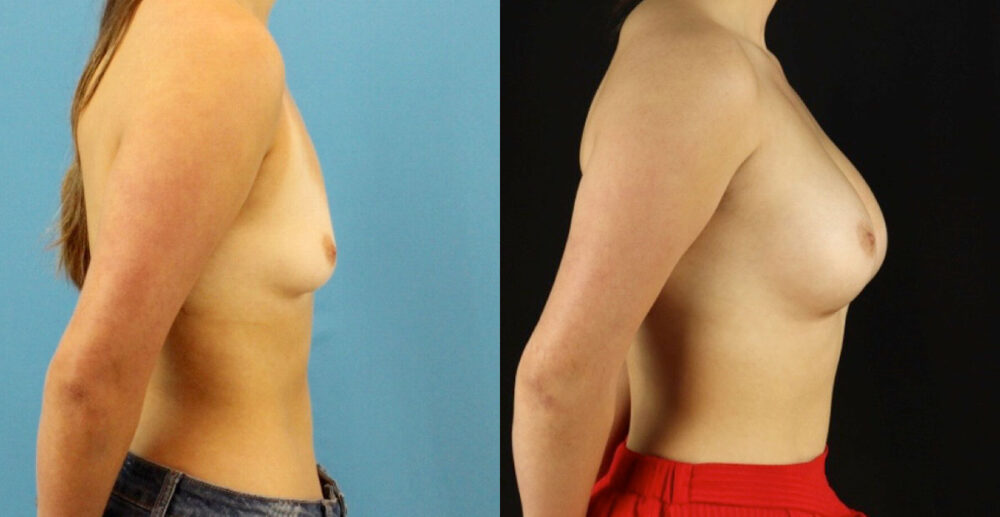 Breast Augmentation case #6327