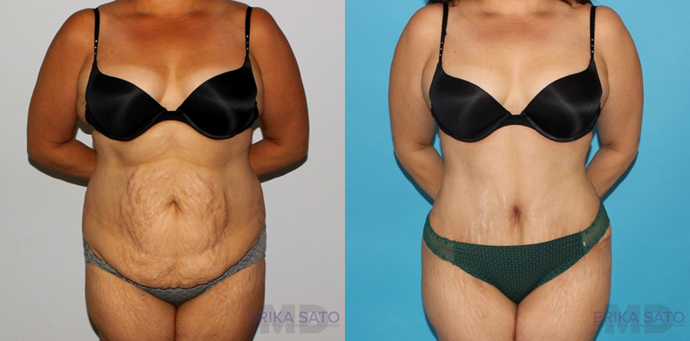 Tummy Tuck case #7165