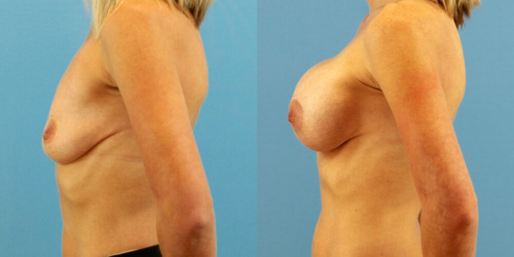 Breast Augmentation case #6333