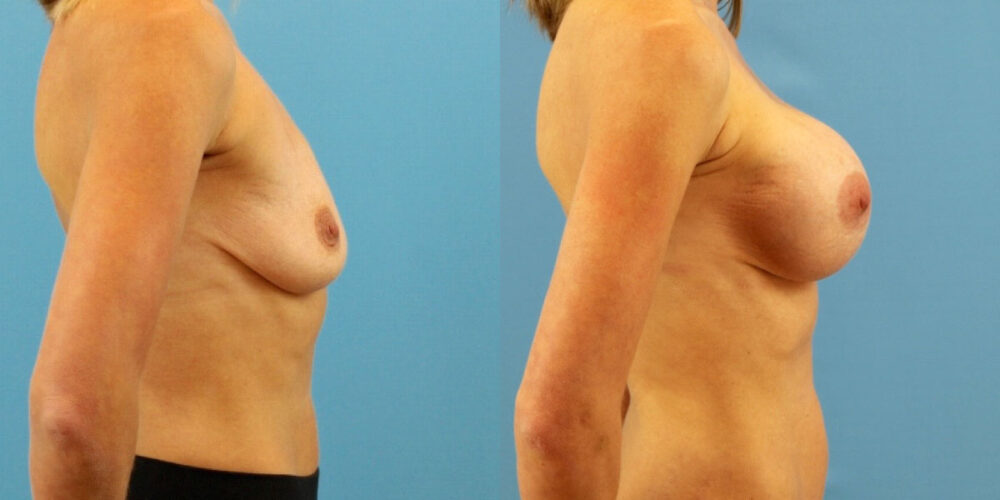 Breast Augmentation case #6333