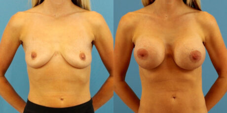 Breast Augmentation case #6333