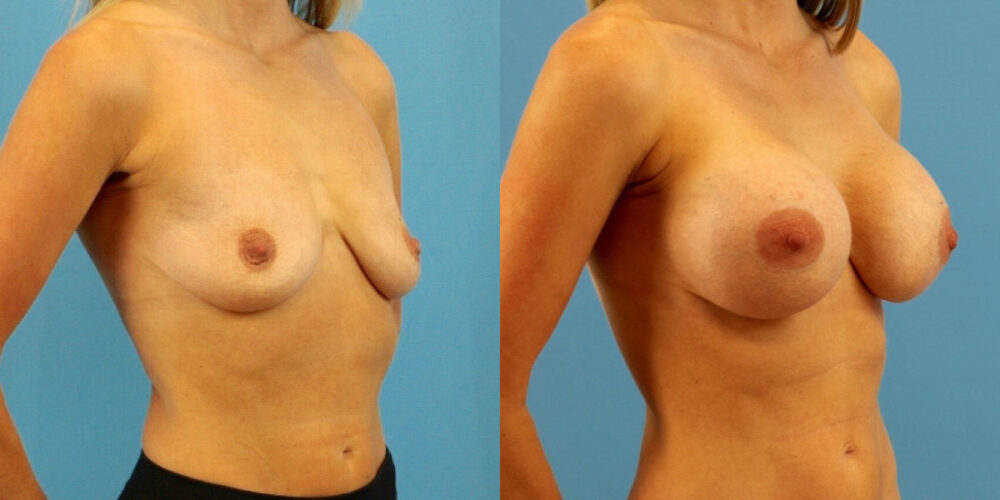 Breast Augmentation case #6333