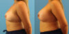 Breast Augmentation case #6340 slider thumbnail