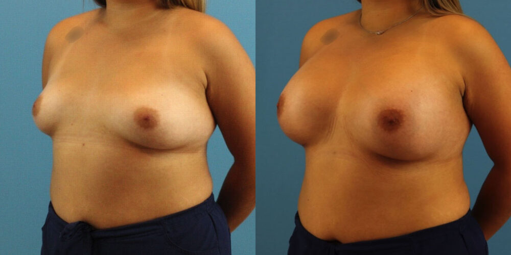Breast Augmentation case #6340