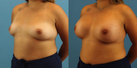 Breast Augmentation case #6340