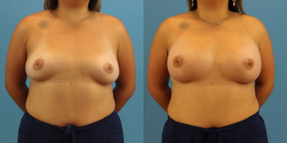 Breast Augmentation case #6340