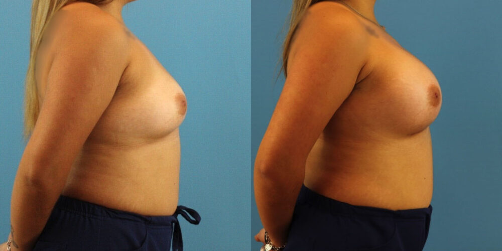 Breast Augmentation case #6340