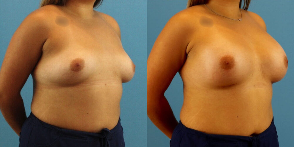 Breast Augmentation case #6340