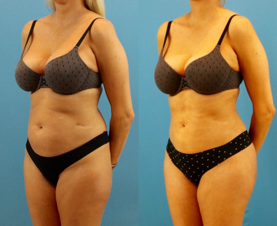 Brazilian Butt Lift case #4964