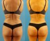 Brazilian Butt Lift case #4964 slider thumbnail