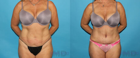 Tummy Tuck case #7087