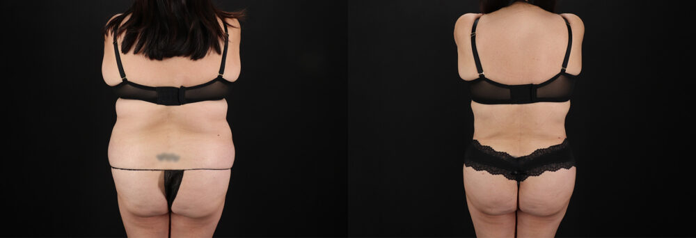 Tummy Tuck case #7774