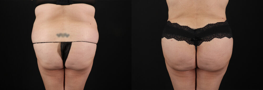 Tummy Tuck case #7774