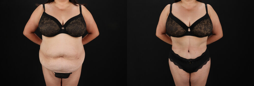 Tummy Tuck case #7774