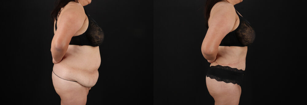 Tummy Tuck case #7774