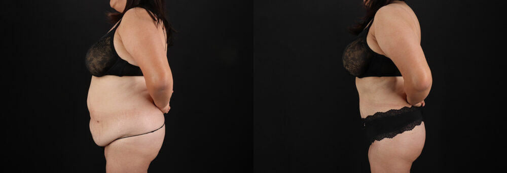 Tummy Tuck case #7774