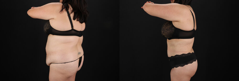 Tummy Tuck case #7774