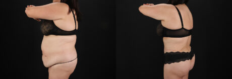 Tummy Tuck case #7774