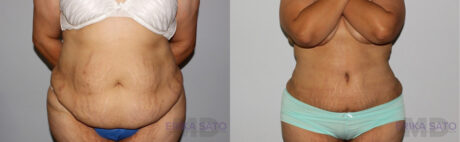 Tummy Tuck case #7085