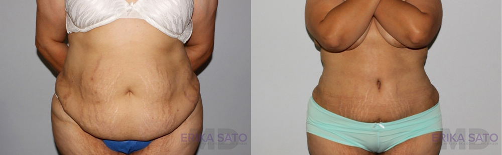 Tummy Tuck case #7085