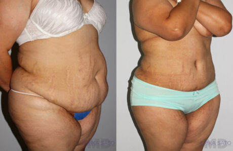 Tummy Tuck case #7085