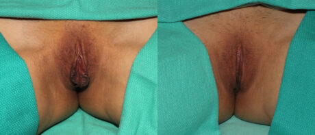 Labiaplasty case #5758