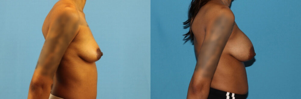 Breast Augmentation case #6346