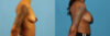 Breast Augmentation case #6346 slider thumbnail