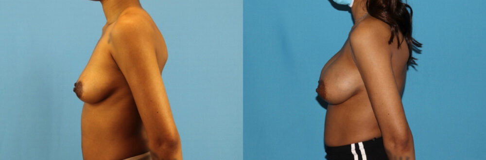 Breast Augmentation case #6346