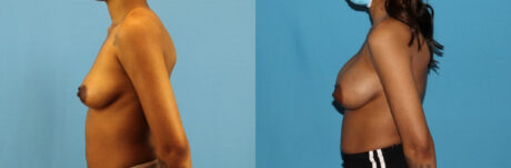 Breast Augmentation case #6346